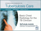 Go to Basic Chest Radiology for the TB Clinician Presentation