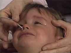 Health care worker places the NG tube in the child's nose.