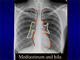 Go to Archived TB Radiology Webinar 