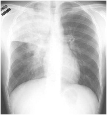 Tracheobronchial abnormalities