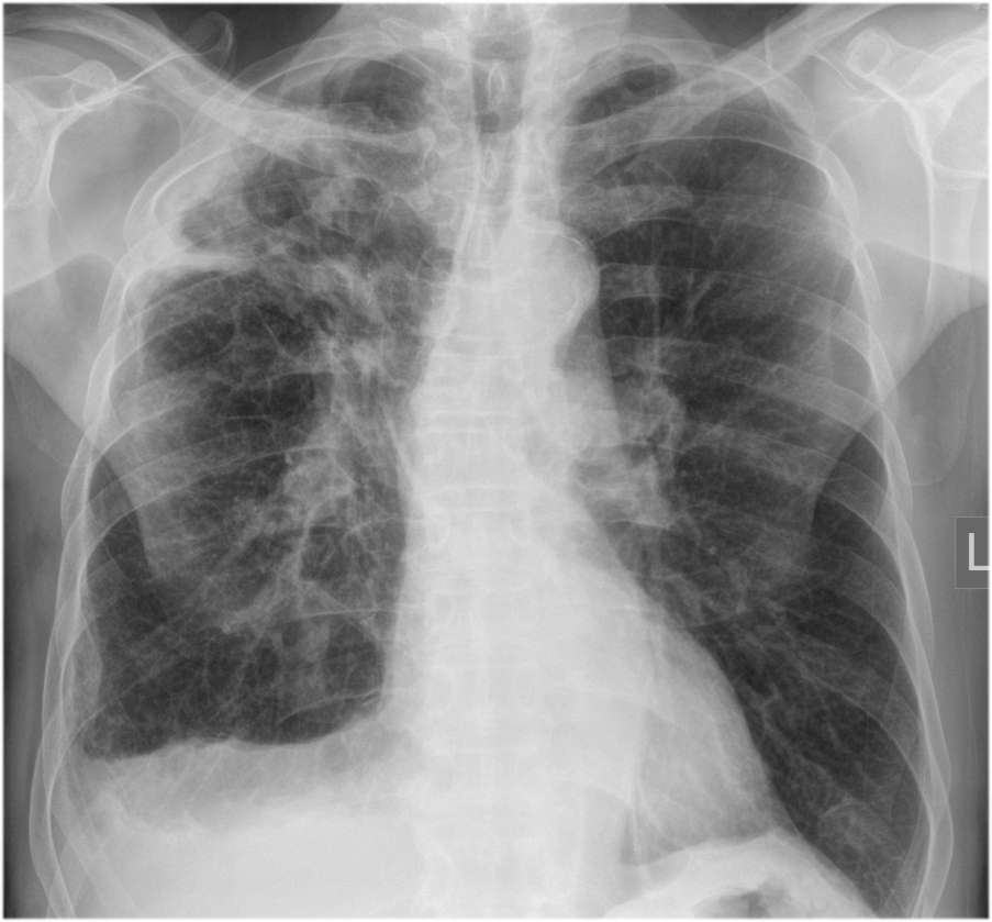 Reticularopacities/ fibrosis (NTM+CA)