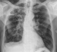 Bilateral apical fibrosis with cavitations