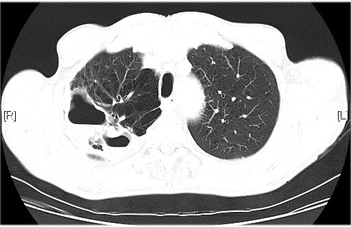 Cavitations/cysts