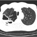 Thin-walled cavitary lesions with air-fluid levels