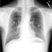 Diffuse bilateral miliary nodules