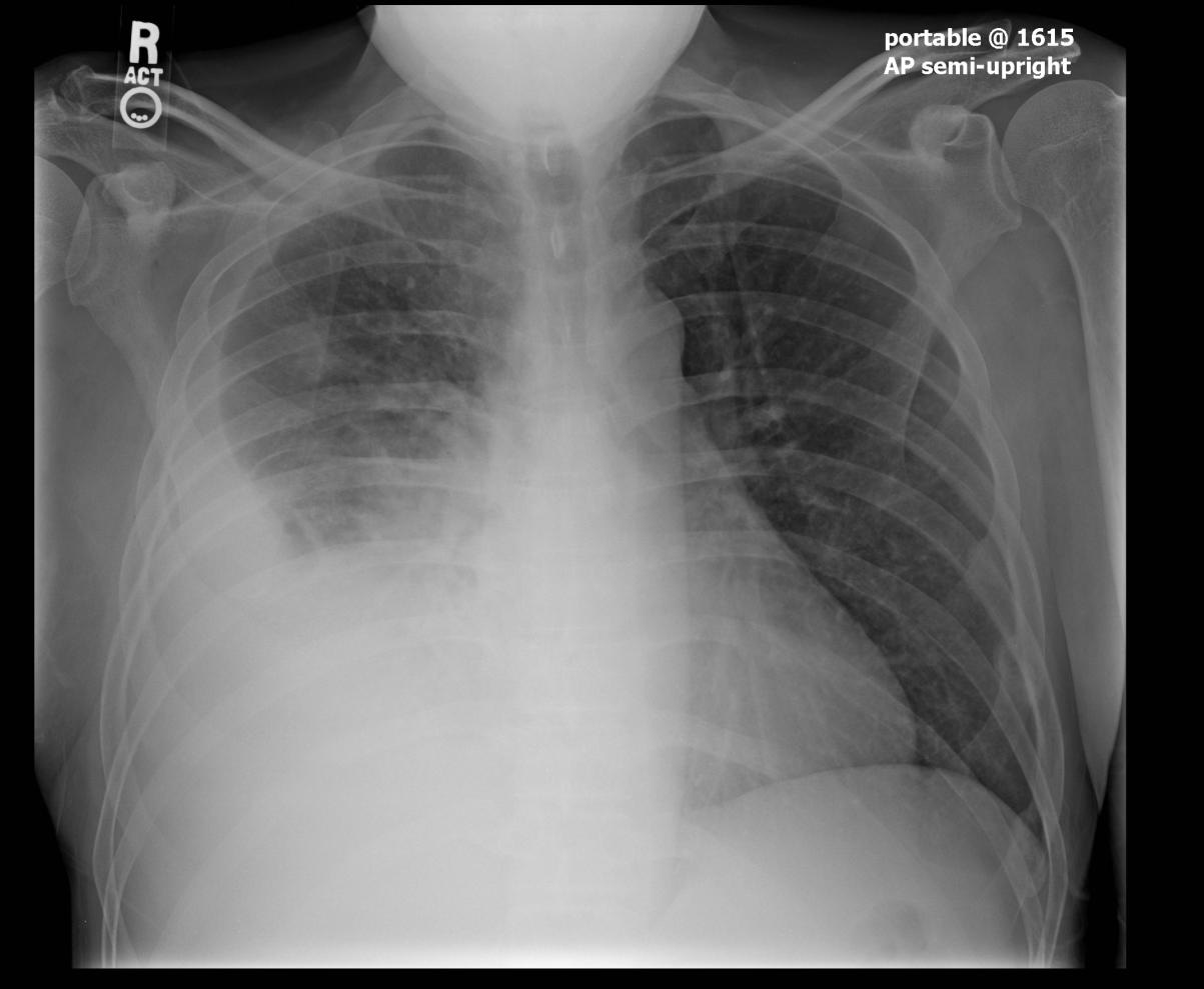 Pleural disease