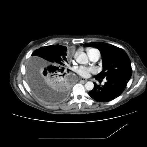 Pleural disease