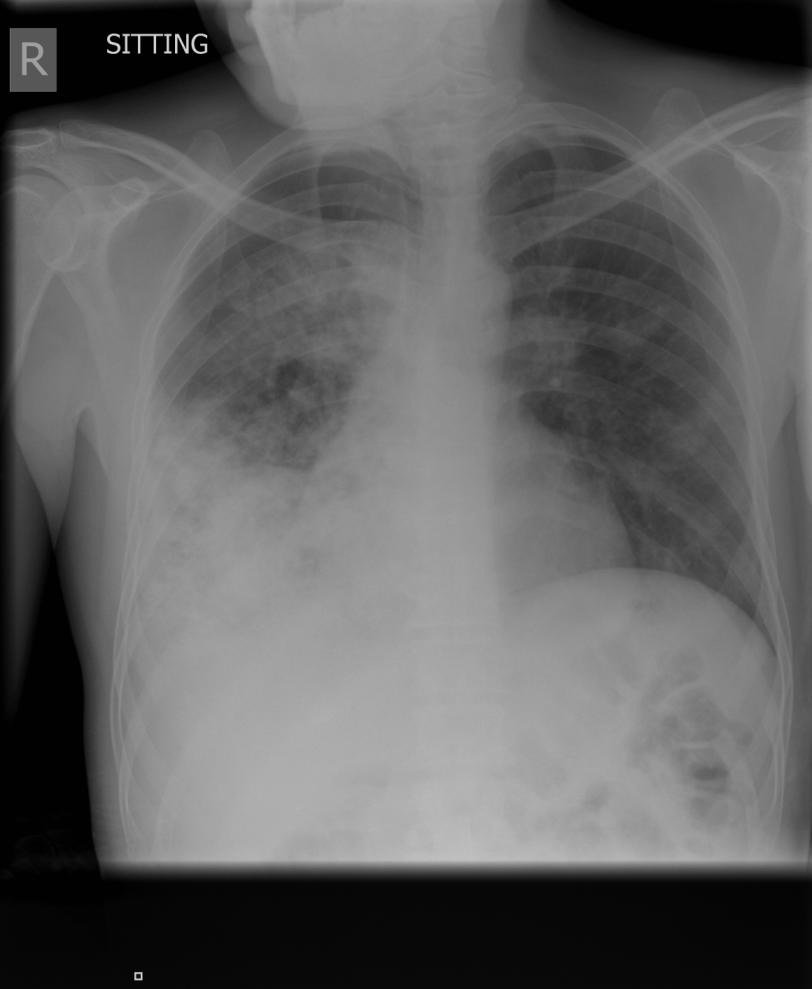 Consolidation/Opacities