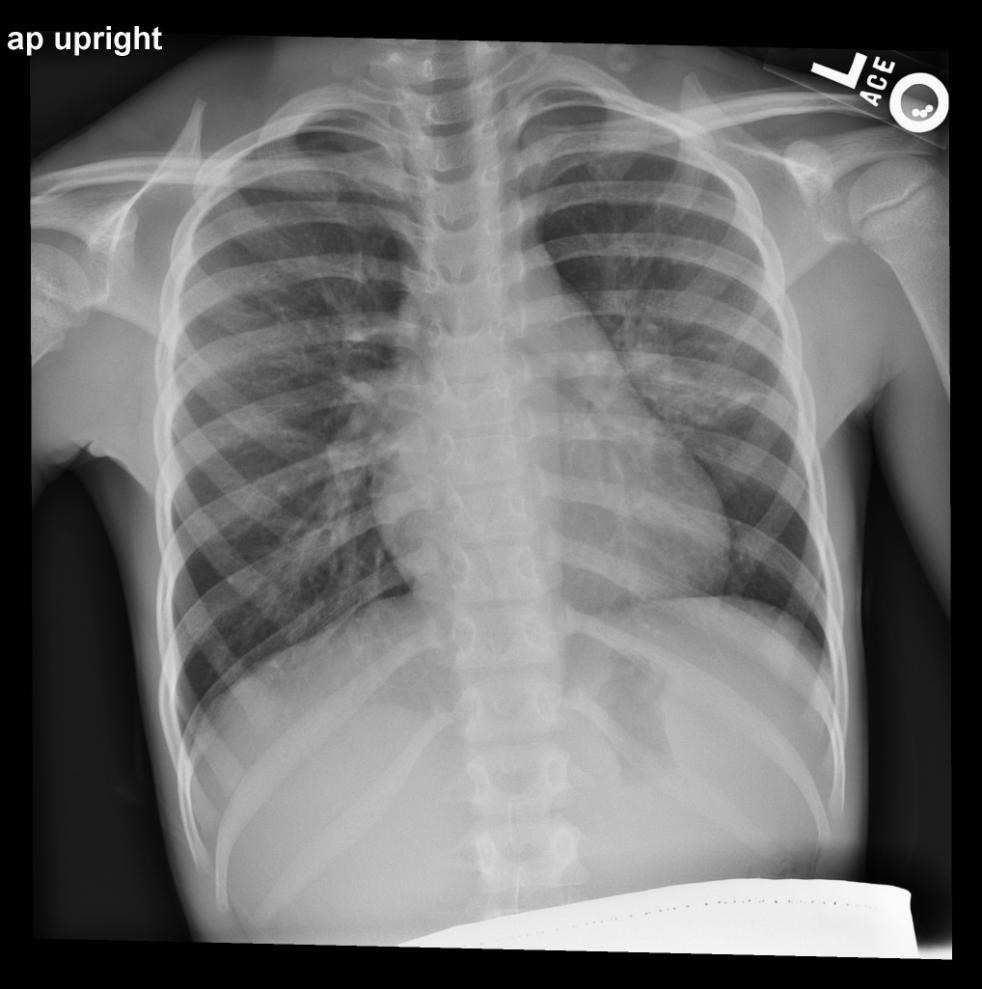 Consolidation/Opacities