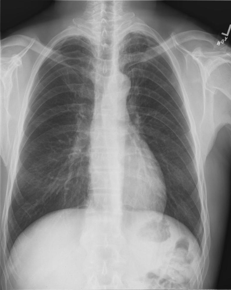 Tracheobronchial abnormalities