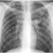 Bilateral apical disease