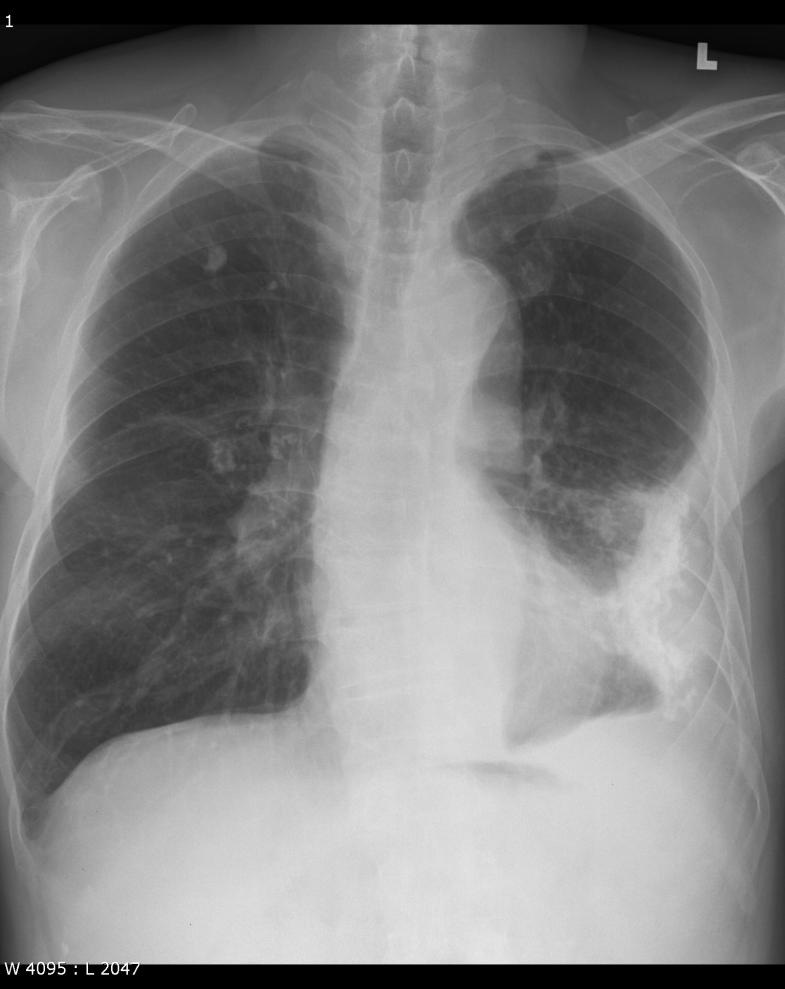 Pleural disease