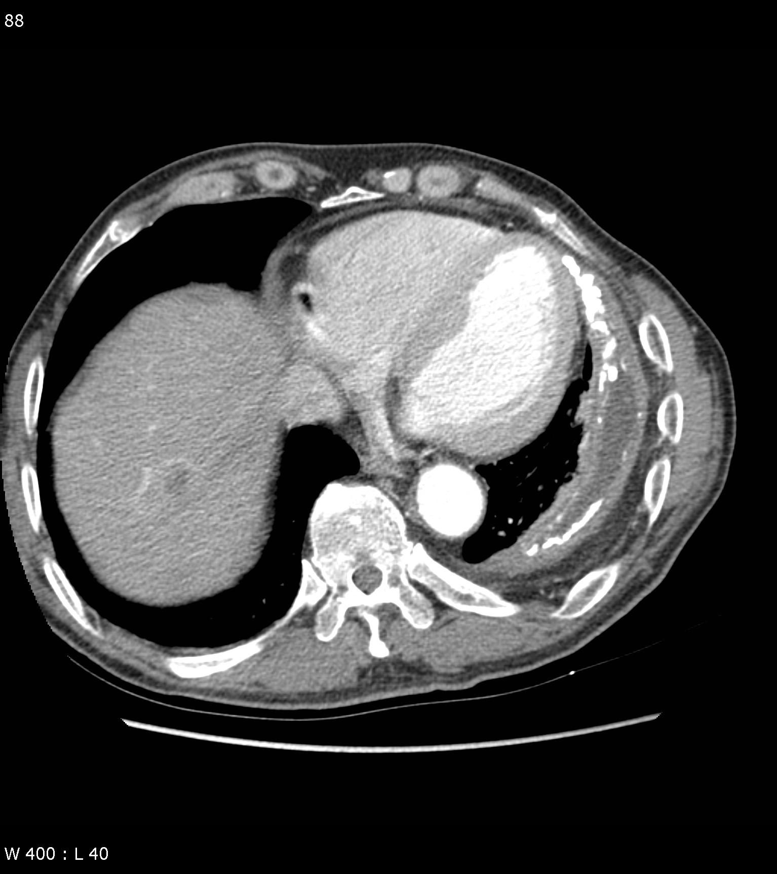 Pleural disease