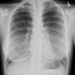 Diffuse bilateral miliary nodules