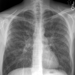 Diffuse bilateral miliary nodules