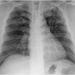 Bilateral apical cavitary disease