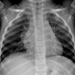 Bilateral apical fibrosis with cavitations