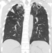 Upper lobes cavities + centrilobular nodules (CXR + CT)