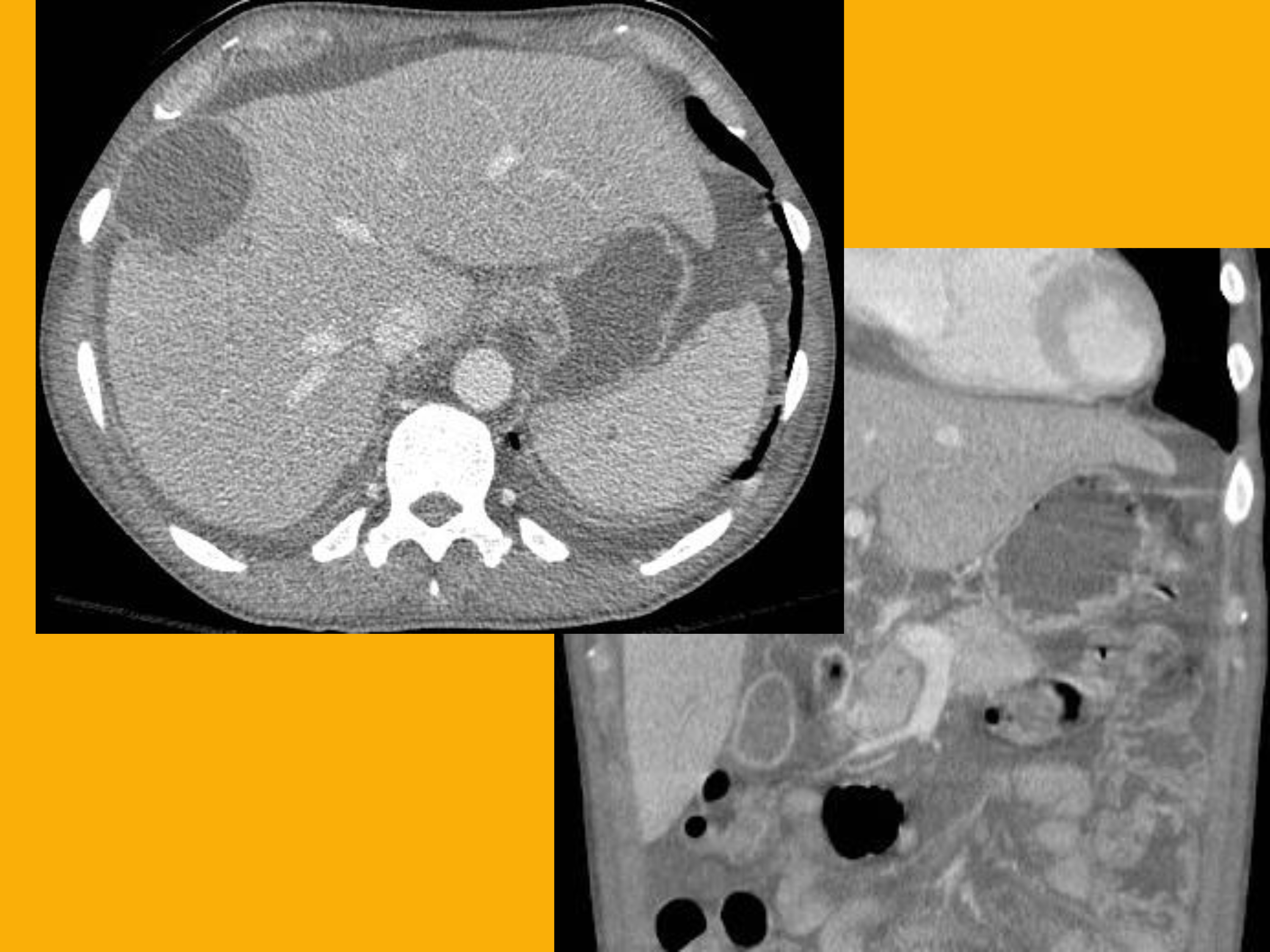 Extra-pulmonary TB