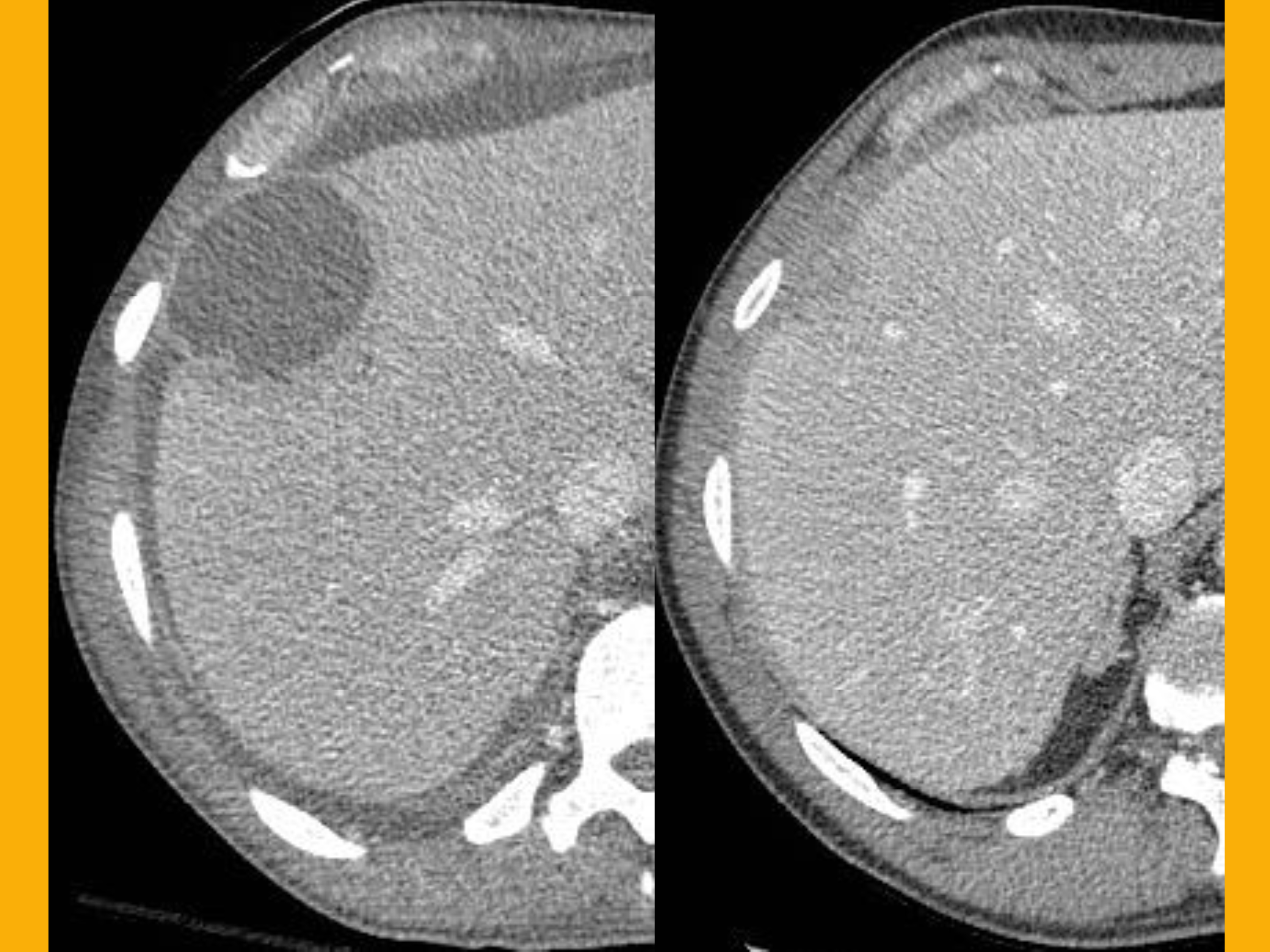 Extra-pulmonary TBs