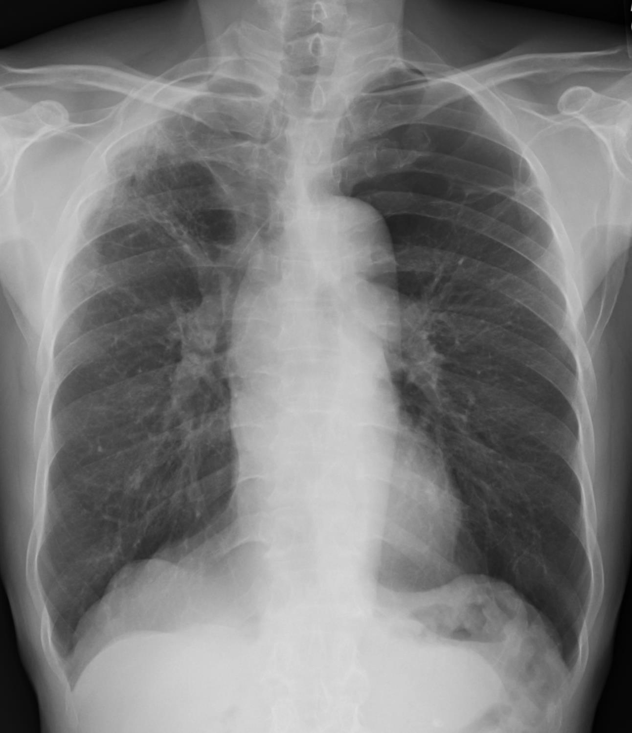 Consolidation/Opacities