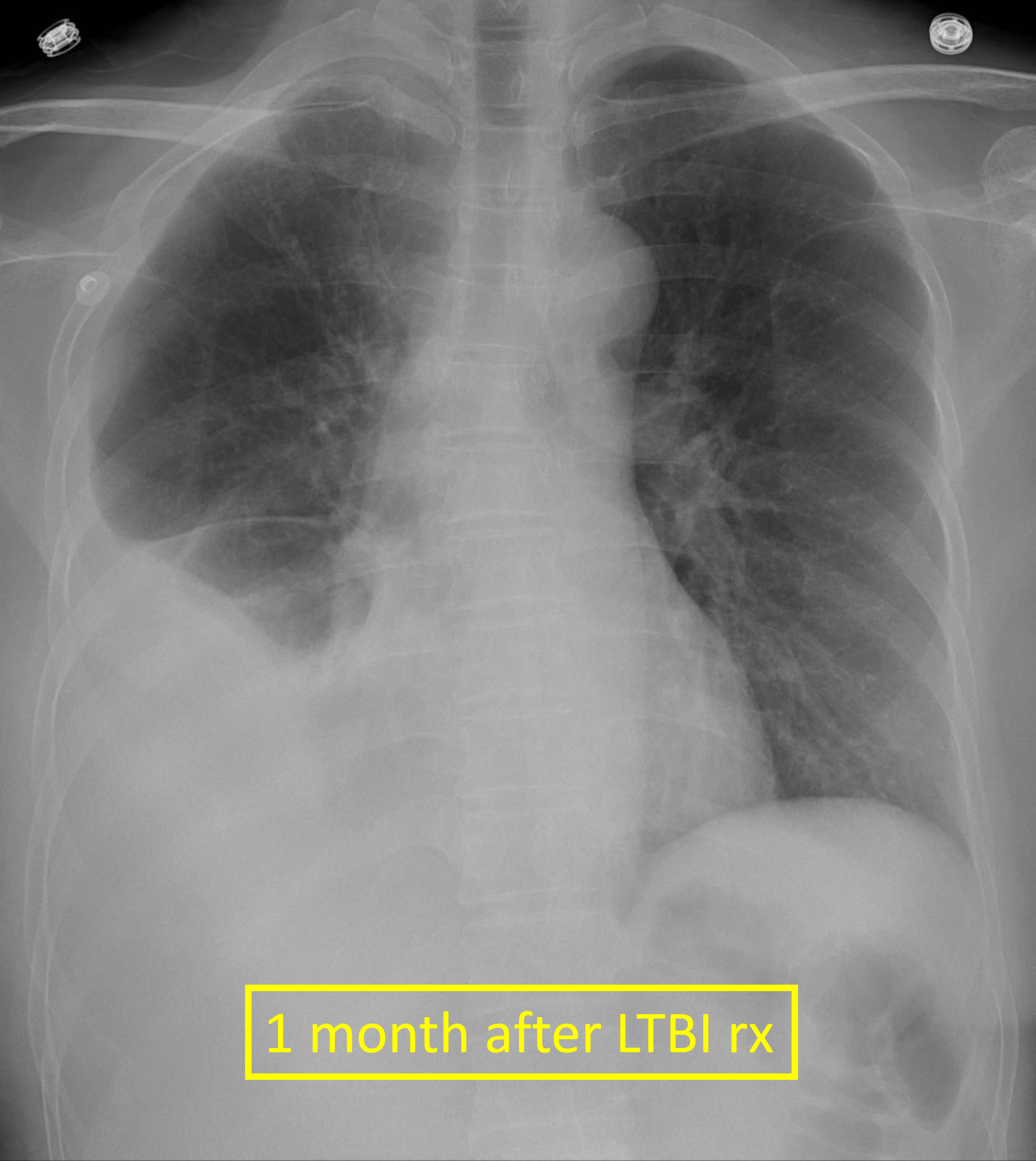 Pleural abnormalities