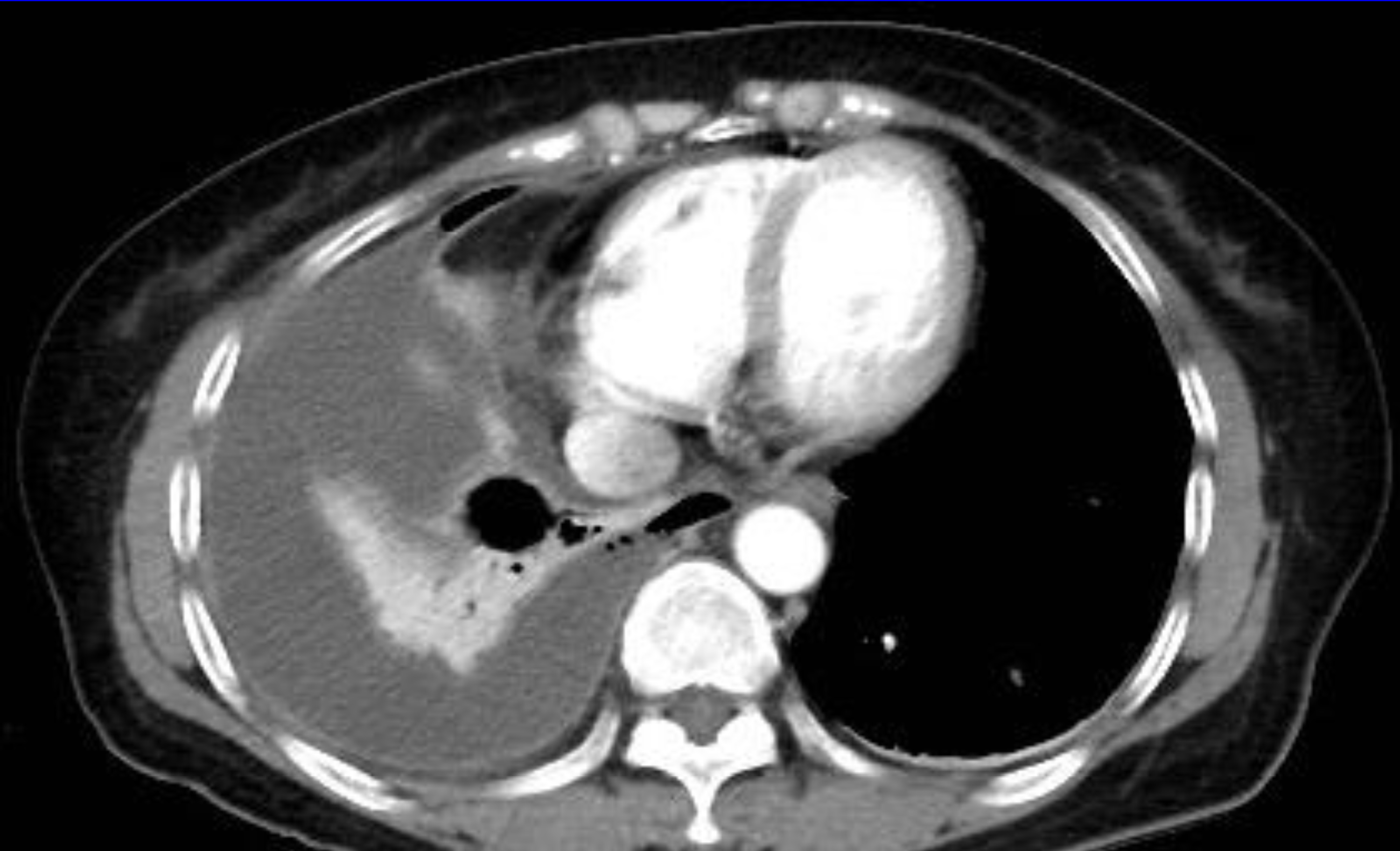 Pleural abnormalities