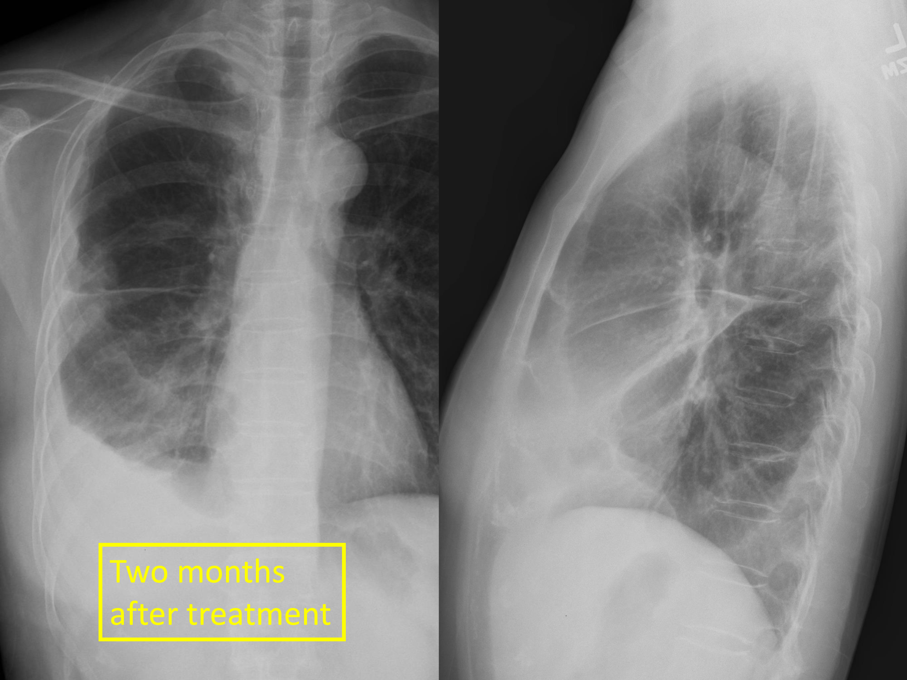 Pleural abnormalities