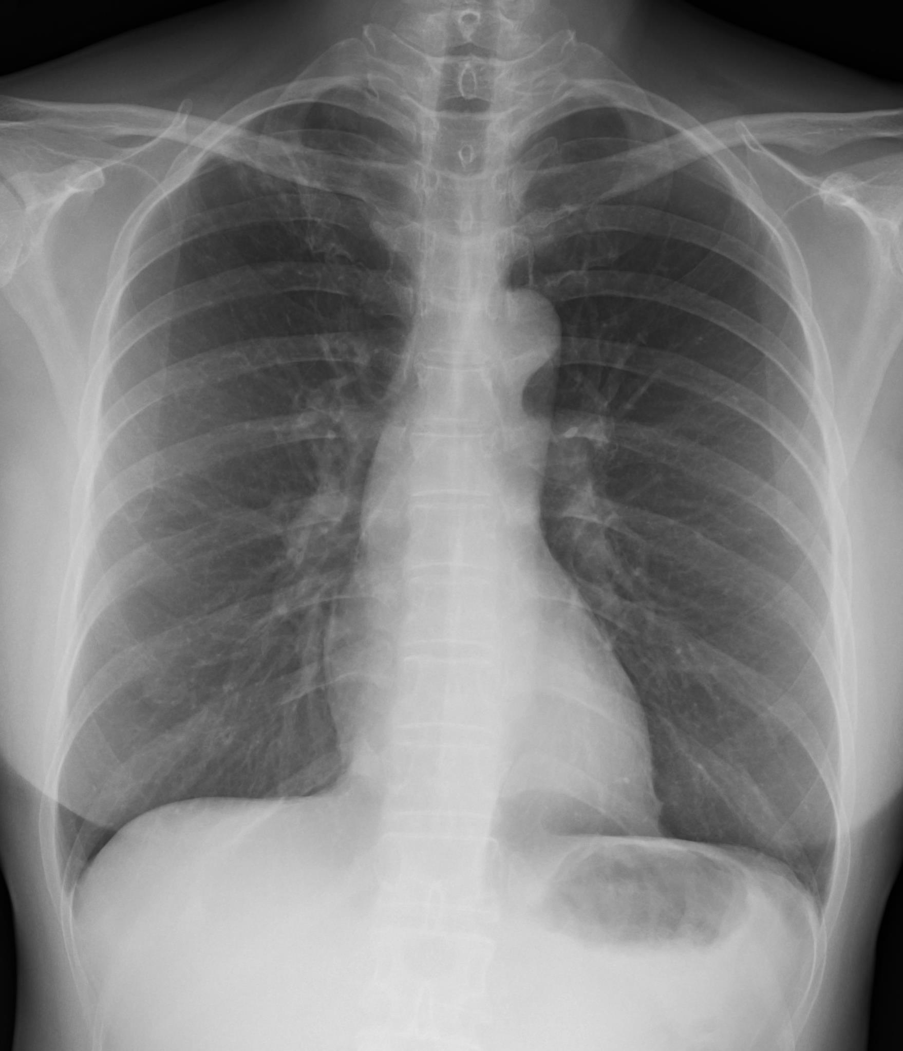 Linear opacities/fibrosis