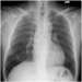 Diffuse bilateral miliary nodules