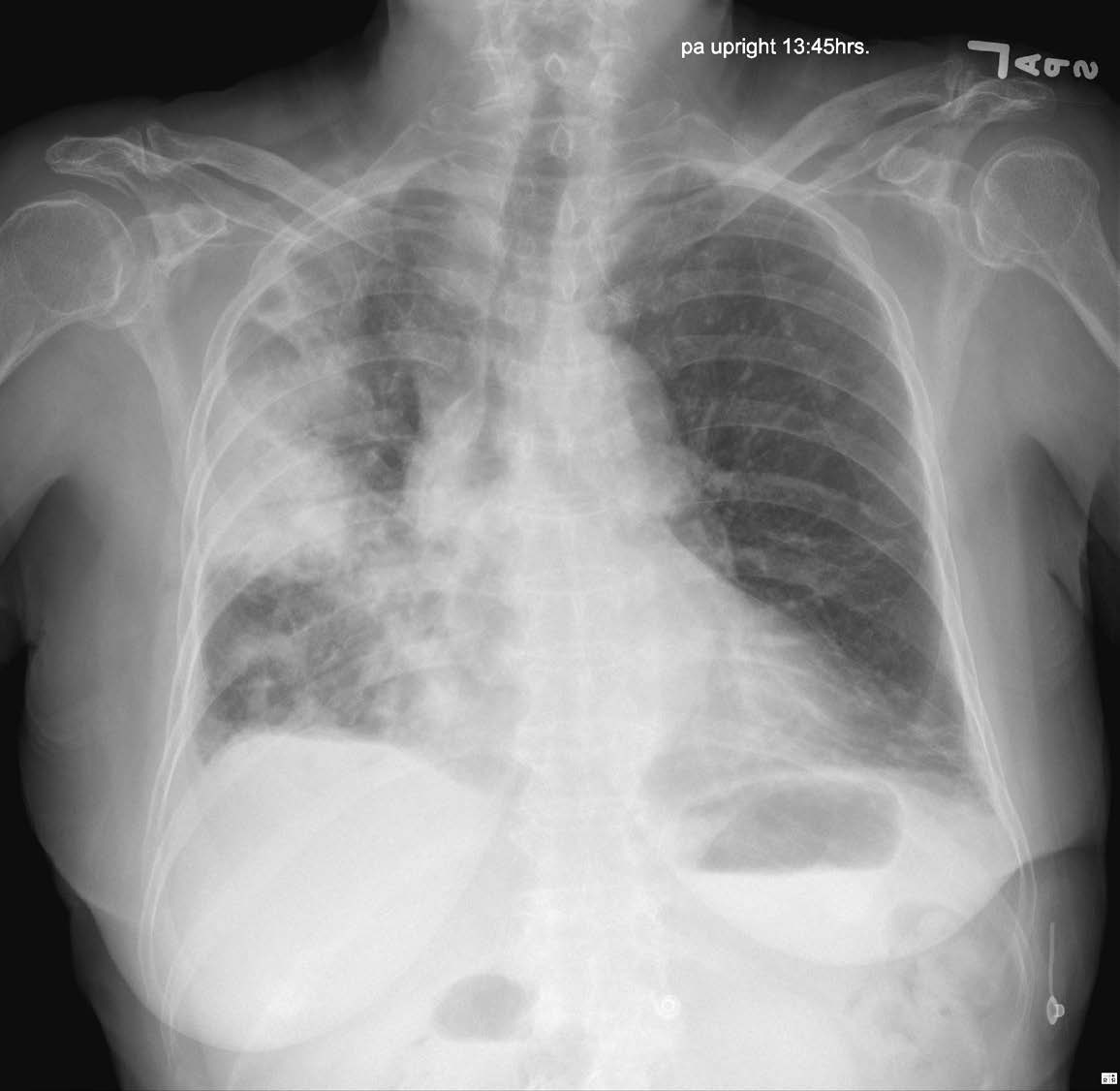 Consolidation/Opacities