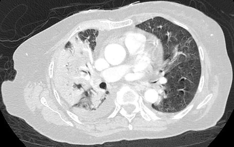 Consolidation/Opacities