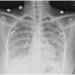 Diffuse bilateral miliary nodules