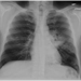 Superior segment left lower lobe