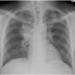 R Hilar adenopathy and consolidations