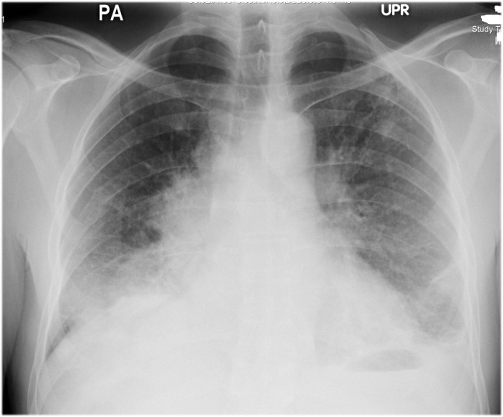 Lymphadenopathy