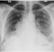 Hilar+paratracheal adenopathy