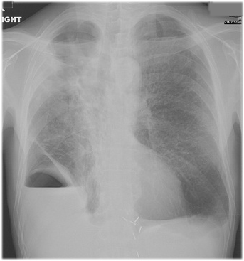 Pleural disease