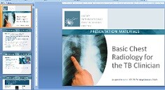 Go to online Basic Chest Radiology for the TB Clinician Presentation Slide Set (Teaching Tool Set 1 of 2) Go to online Basic Chest Radiology for the TB Clinician Presentation Slide Set (Teaching Tool Set 1 of 2)