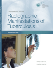 Cover of Radiographic Manifestations of Tuberculosis